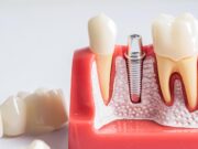 Имплантация зубов: как современное решение стоматологических проблем