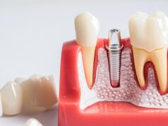 Имплантация зубов: как современное решение стоматологических проблем