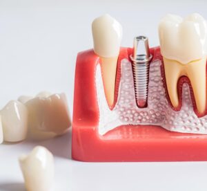 Имплантация зубов: как современное решение стоматологических проблем