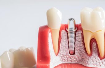 Имплантация зубов: как современное решение стоматологических проблем