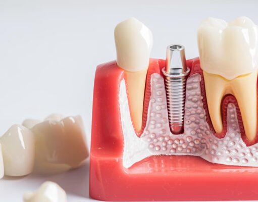 Имплантация зубов: как современное решение стоматологических проблем